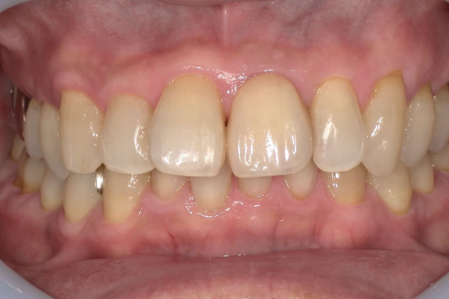 症例③インプラント治療後