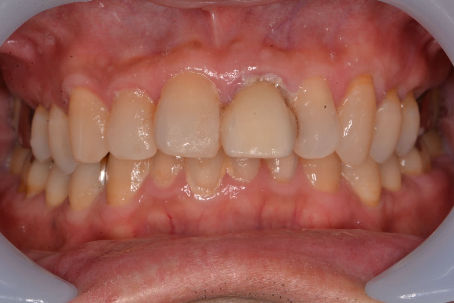 症例③インプラント治療前