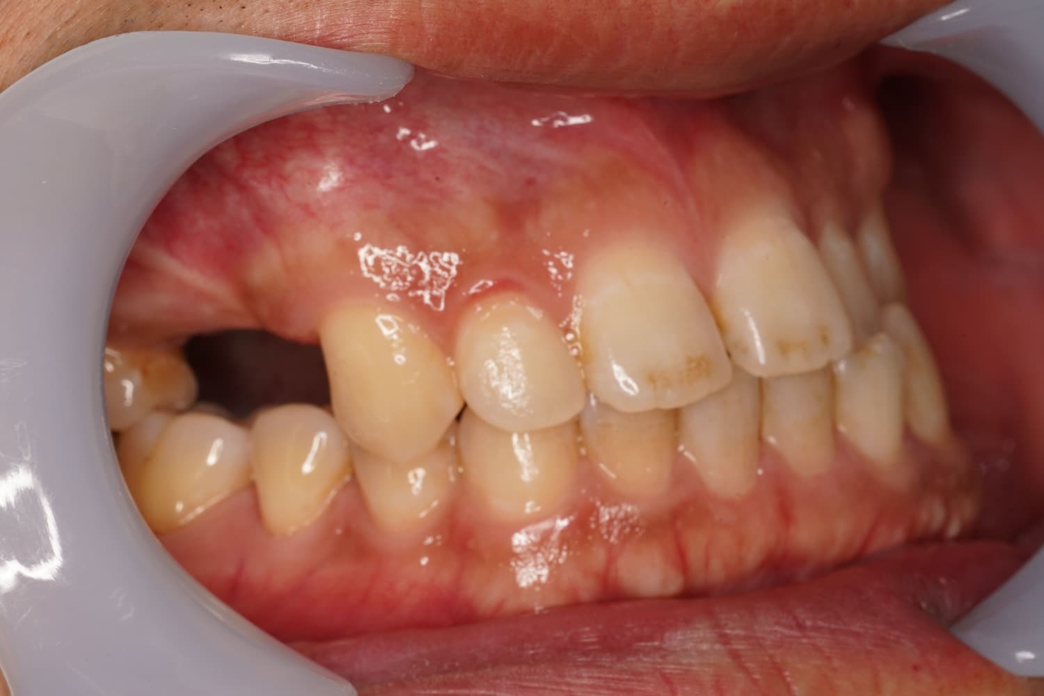 症例②インプラント治療前