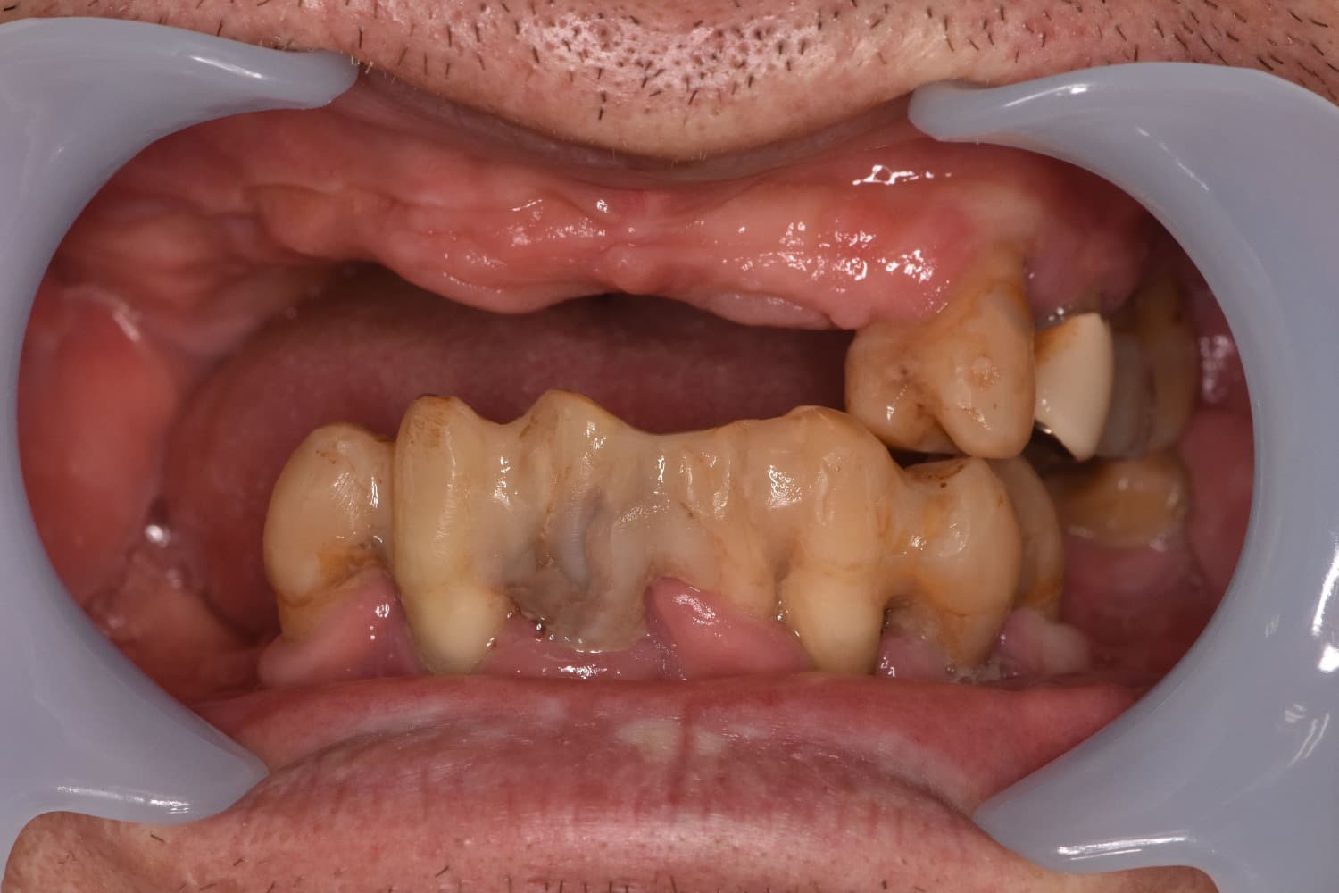 症例①インプラント治療前