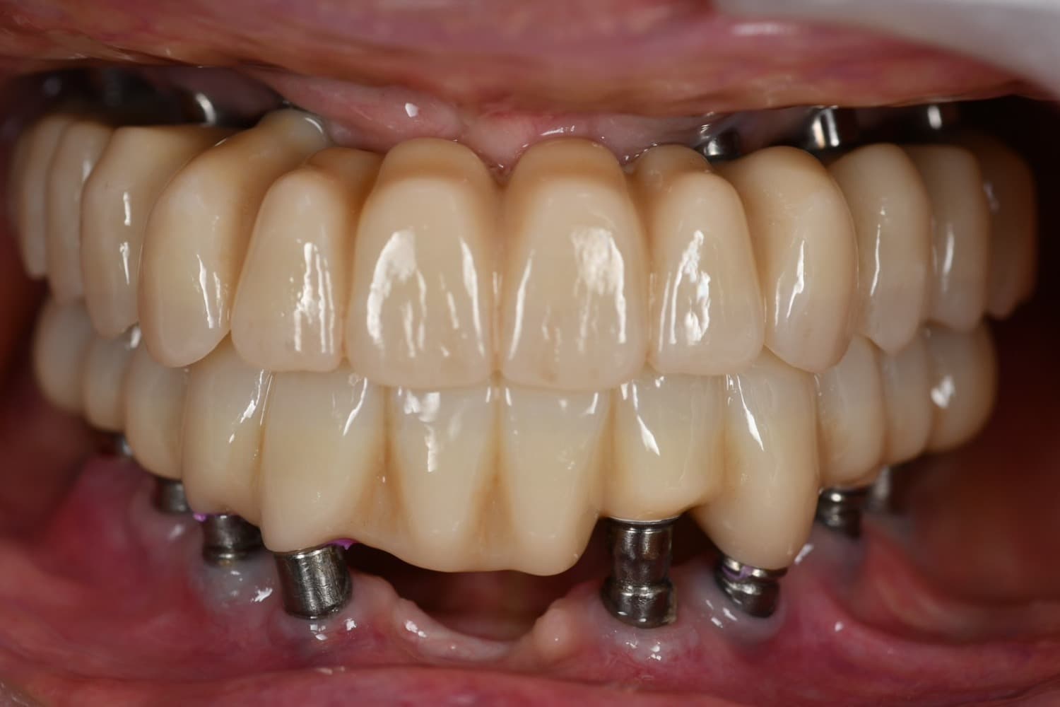 インプラントのメインテナンス後