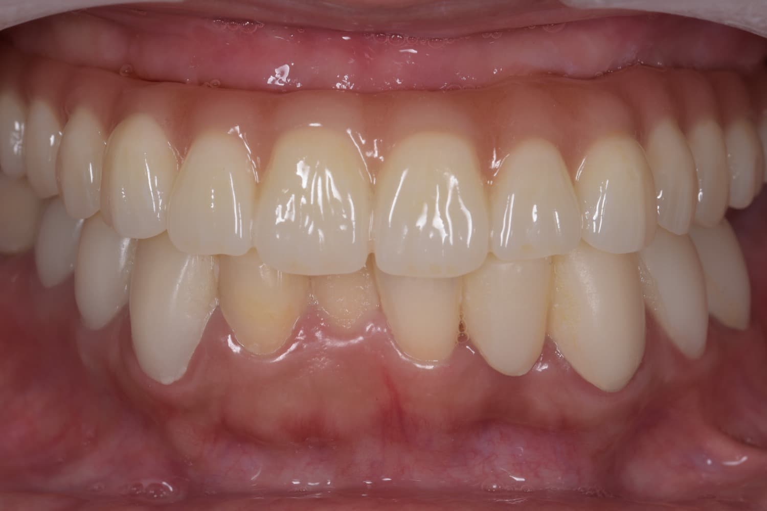 インプラント治療後