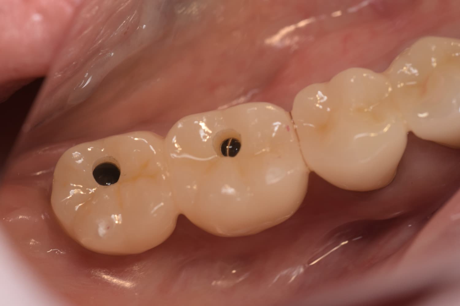 インプラント治療後