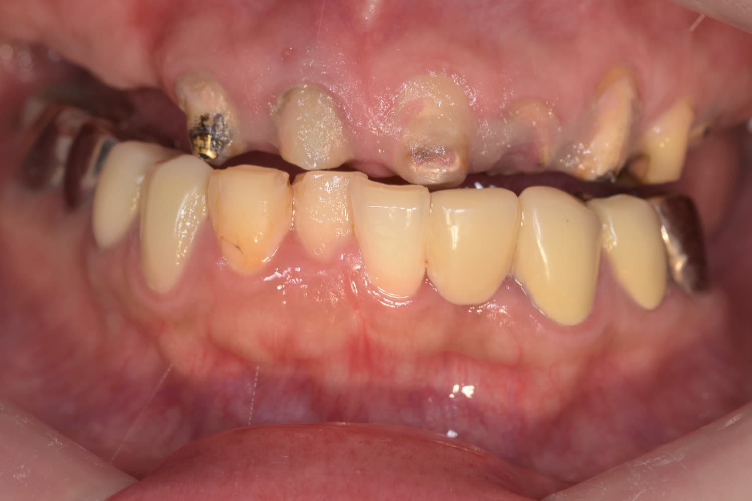 インプラント治療前