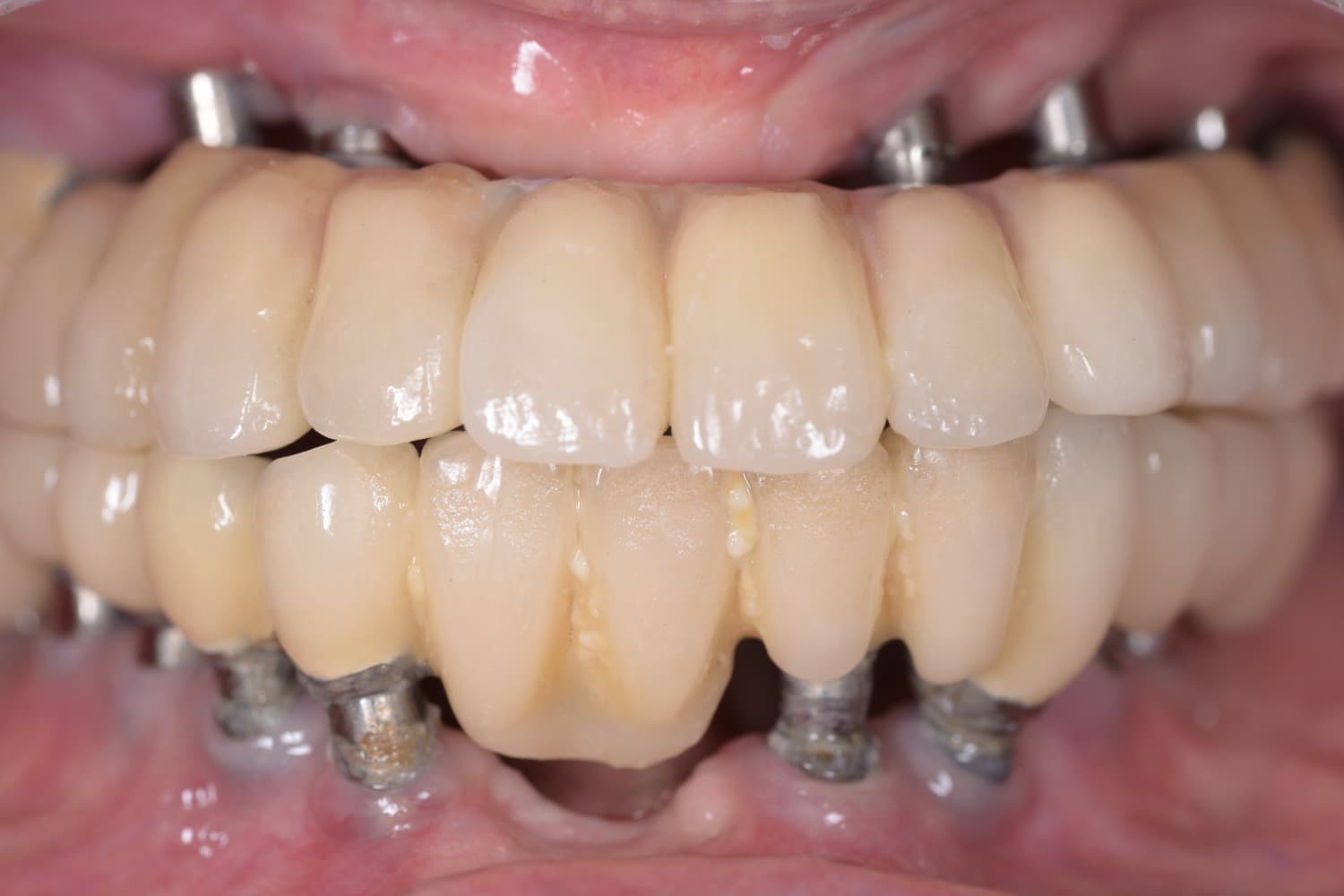 インプラントのメインテナンス前