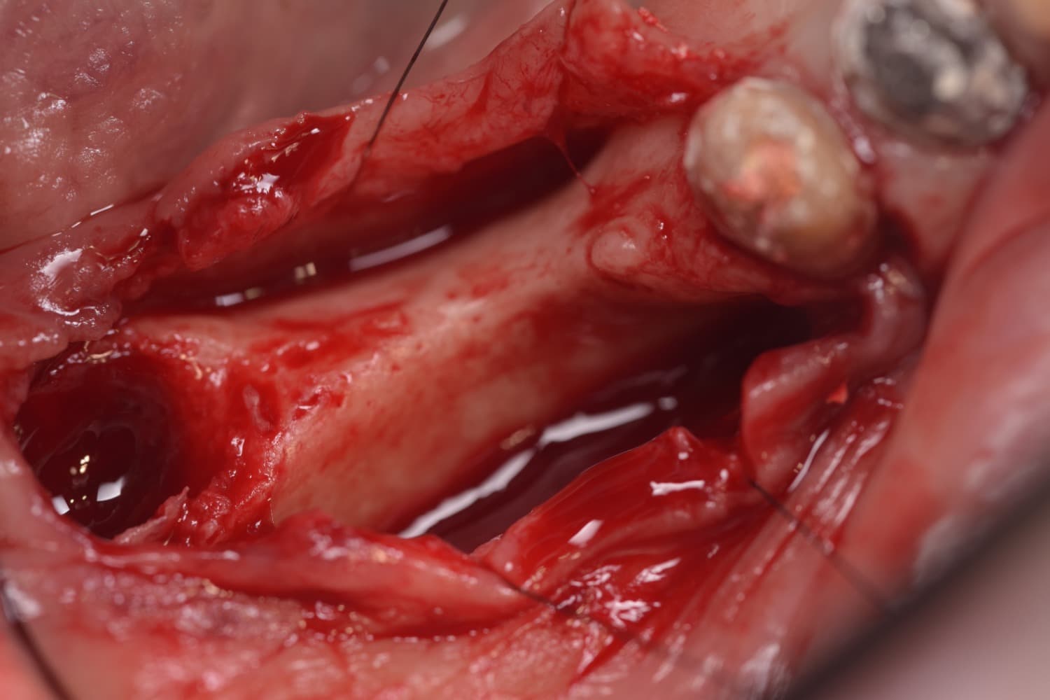 インプラント治療前