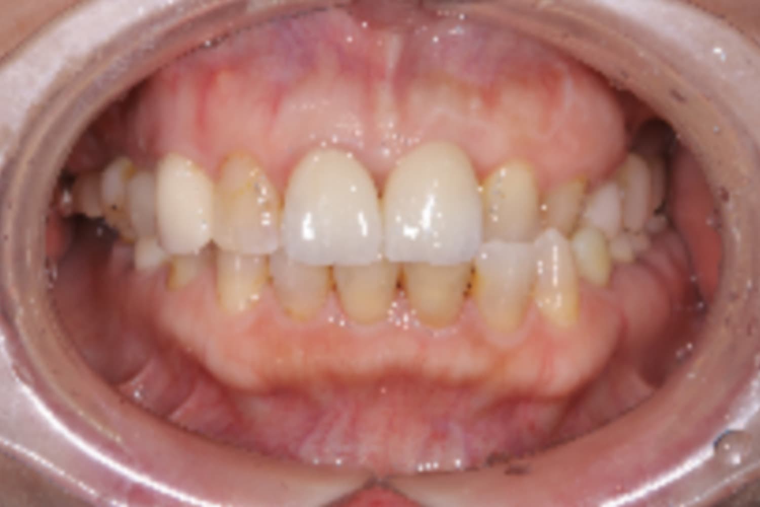 インプラント治療後