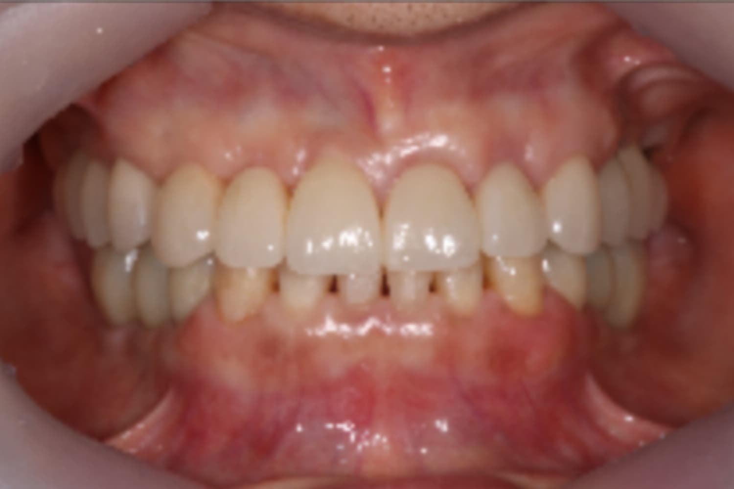 インプラント治療後①