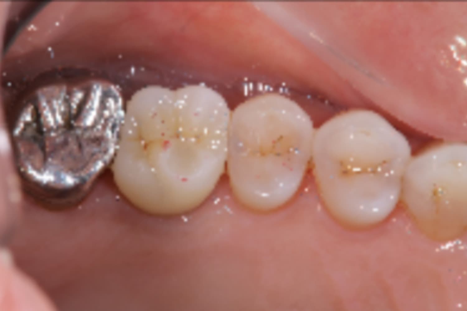 インプラント治療後