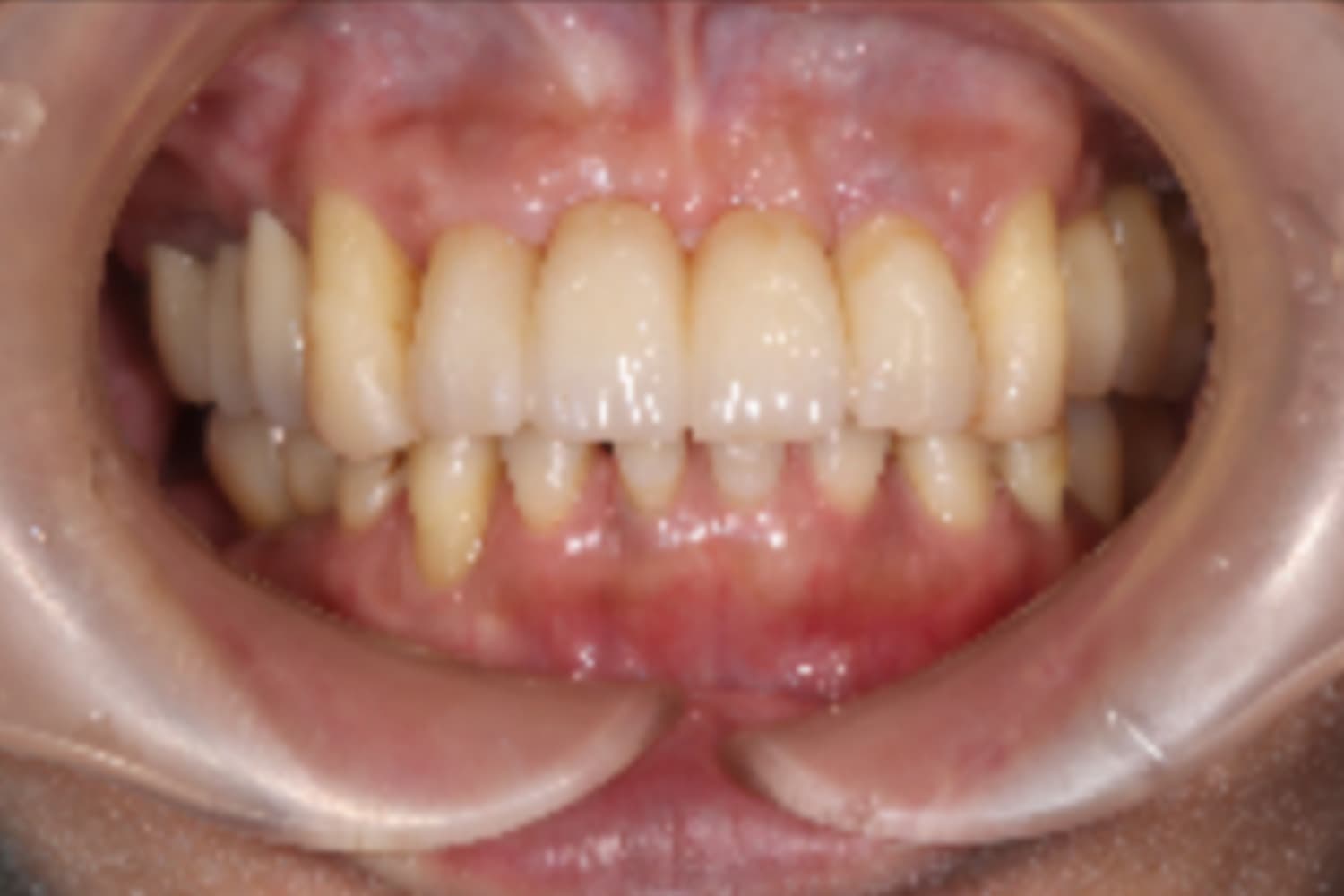 インプラント治療後