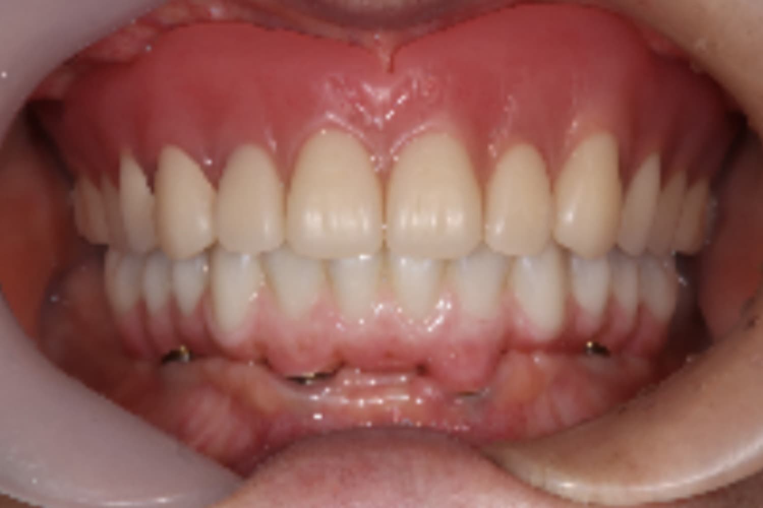 インプラント治療後①