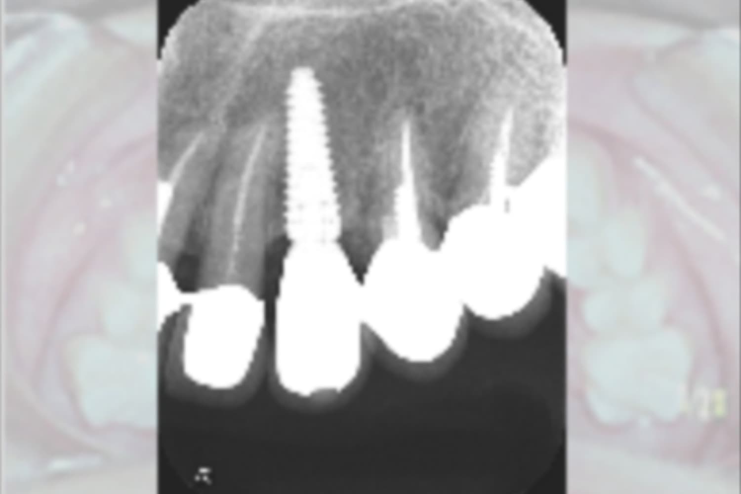 インプラント治療後②