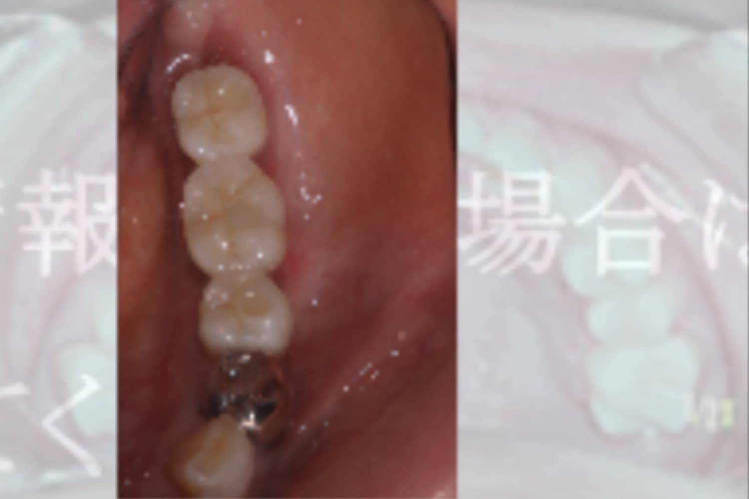 インプラント治療後②