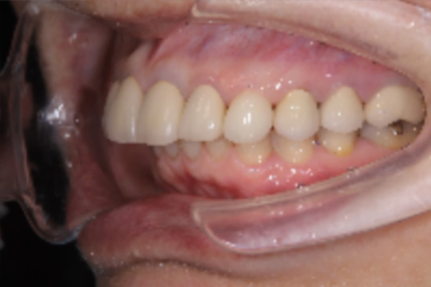 インプラント治療後①