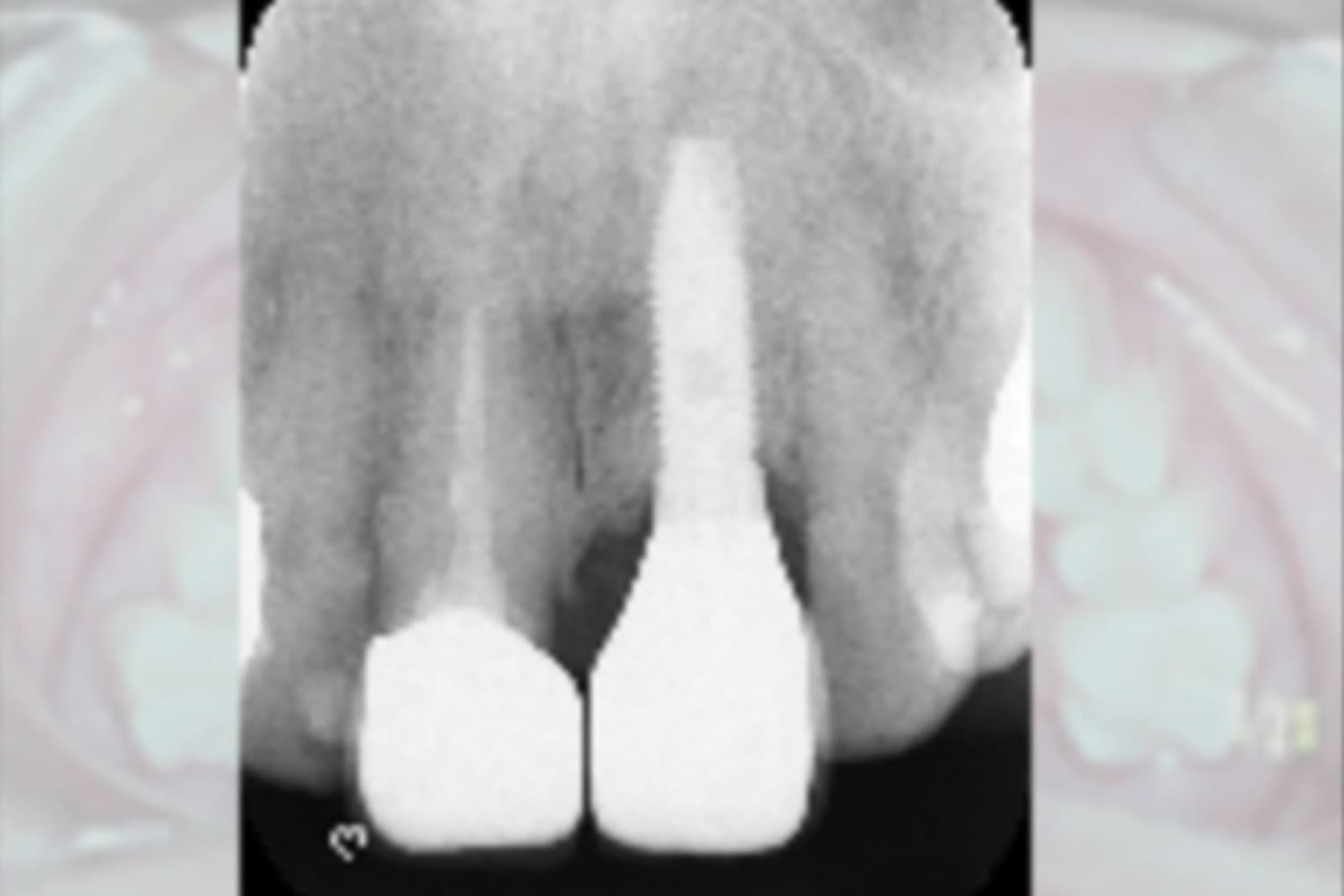 インプラント治療後(レントゲン)