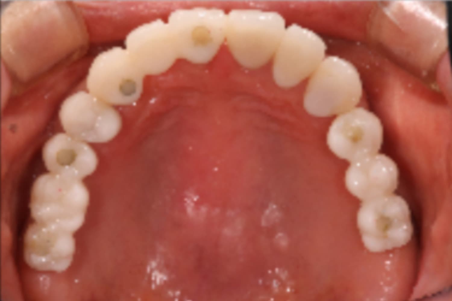 インプラント治療後②