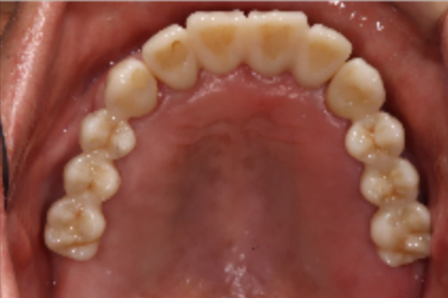 インプラント治療後①