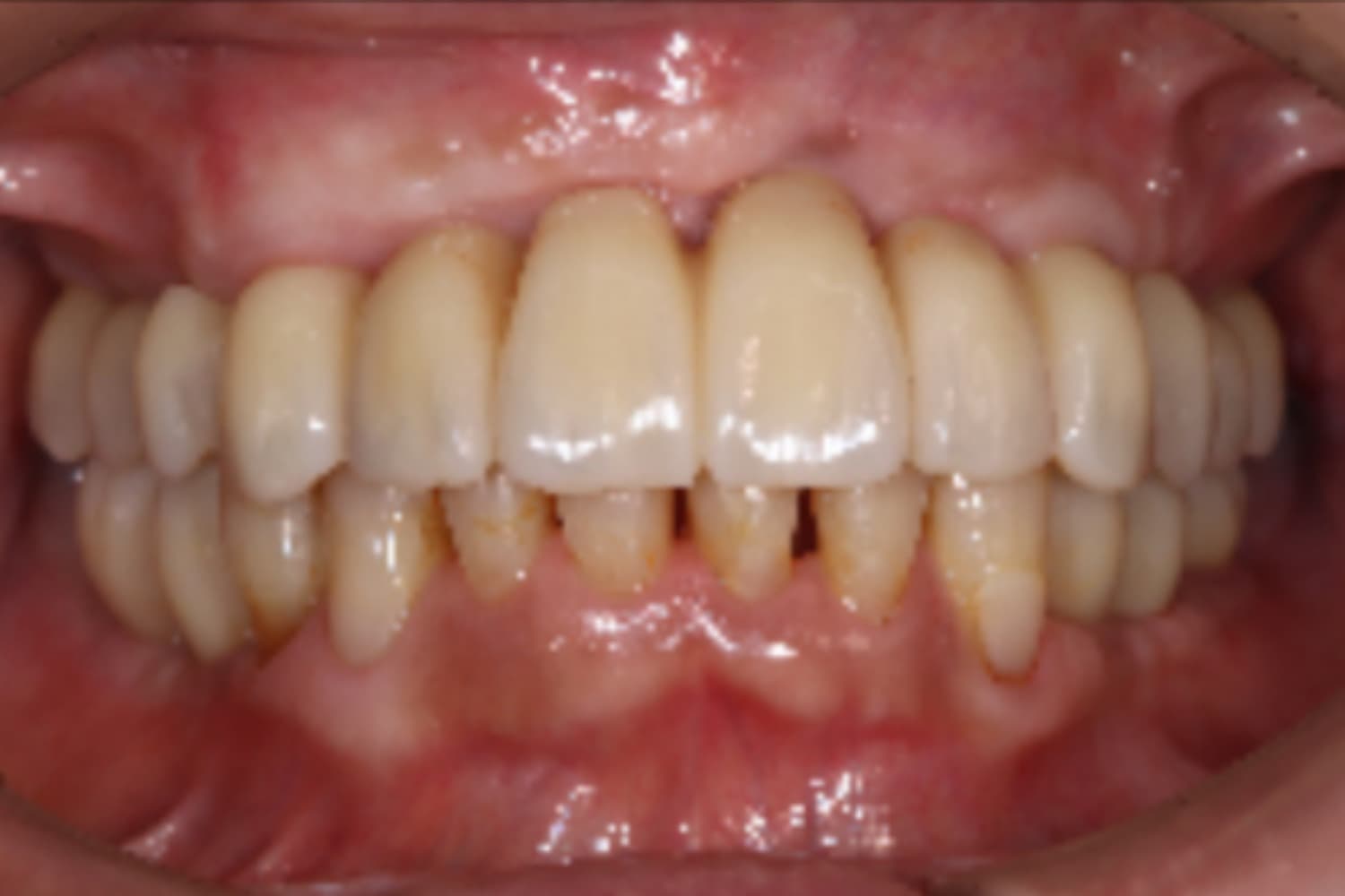 インプラント治療後②