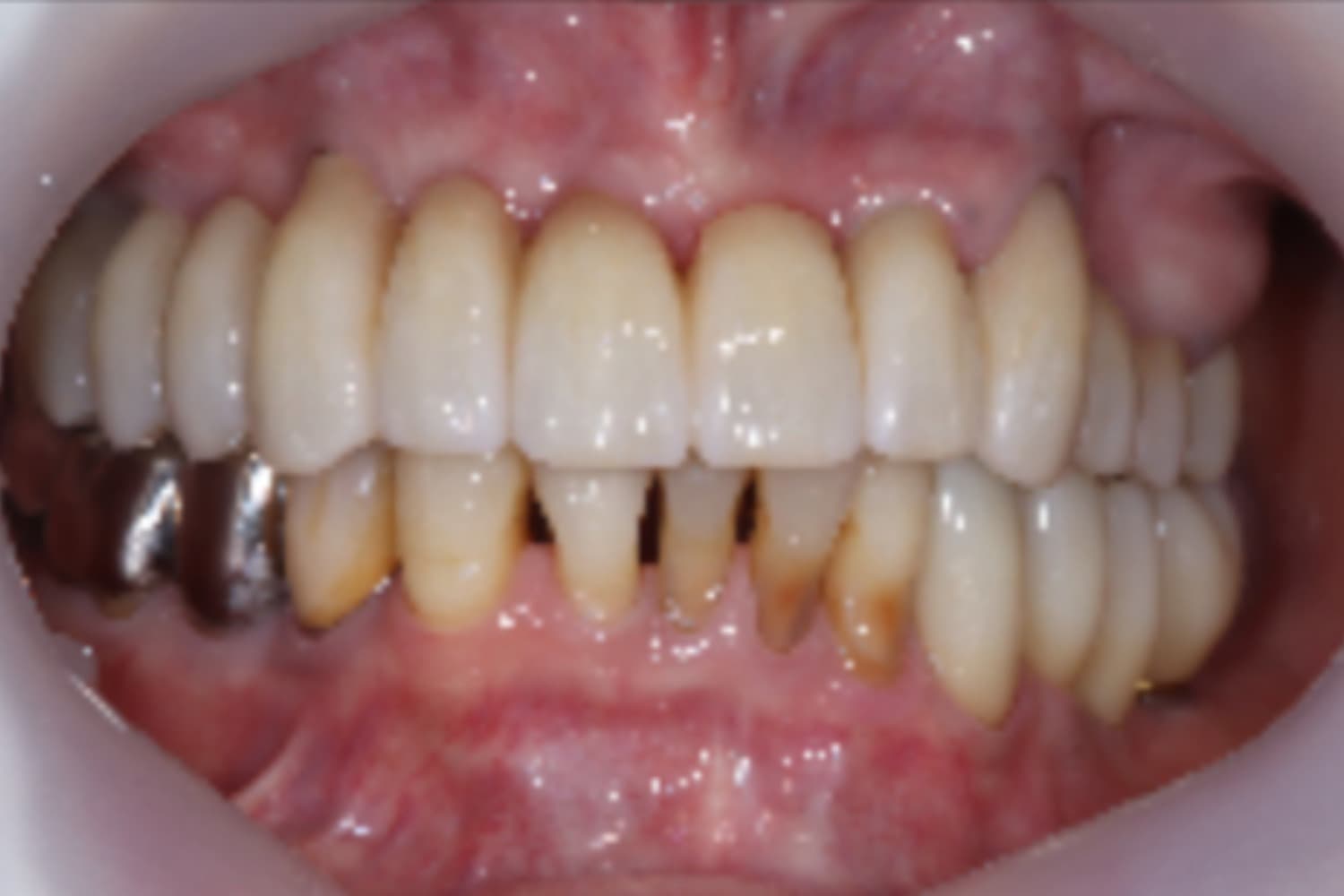 インプラント治療後②