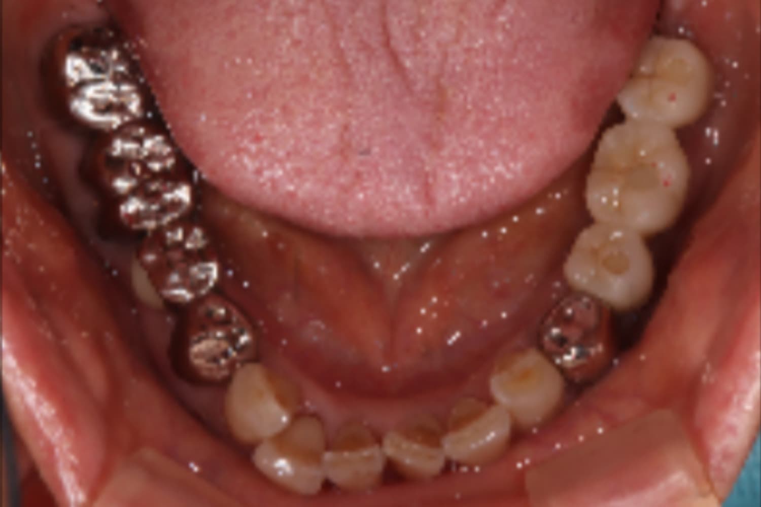 インプラント治療後①