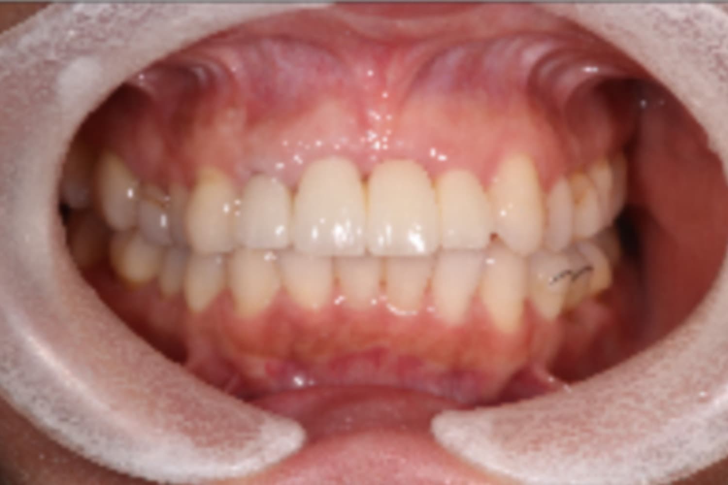 インプラント治療前後