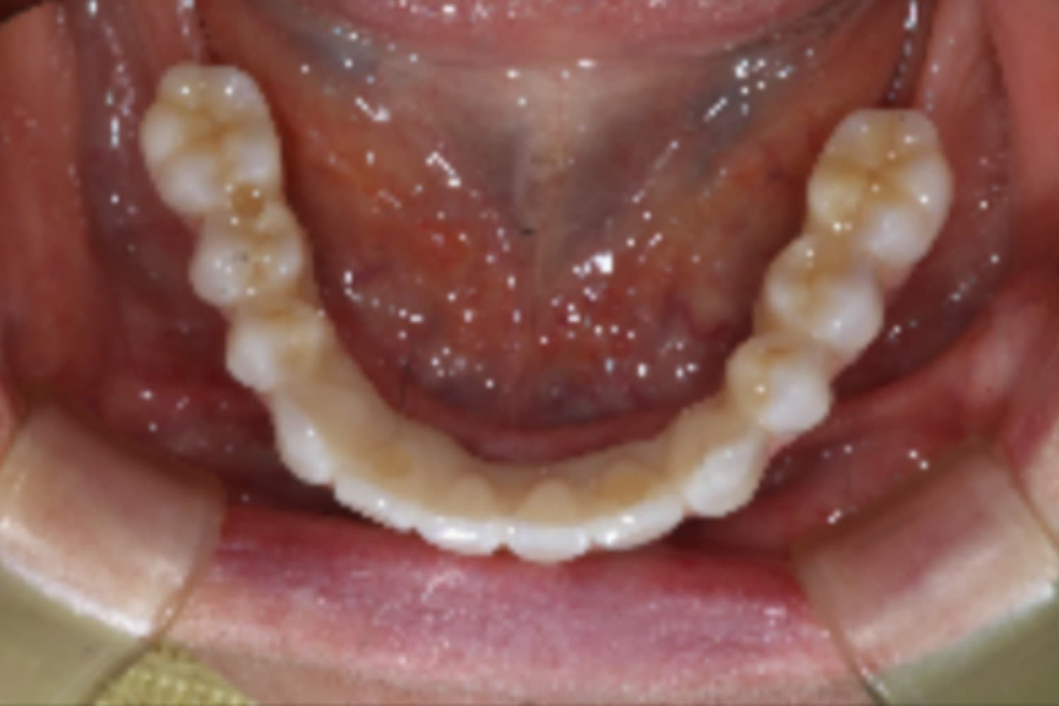 インプラント治療後②