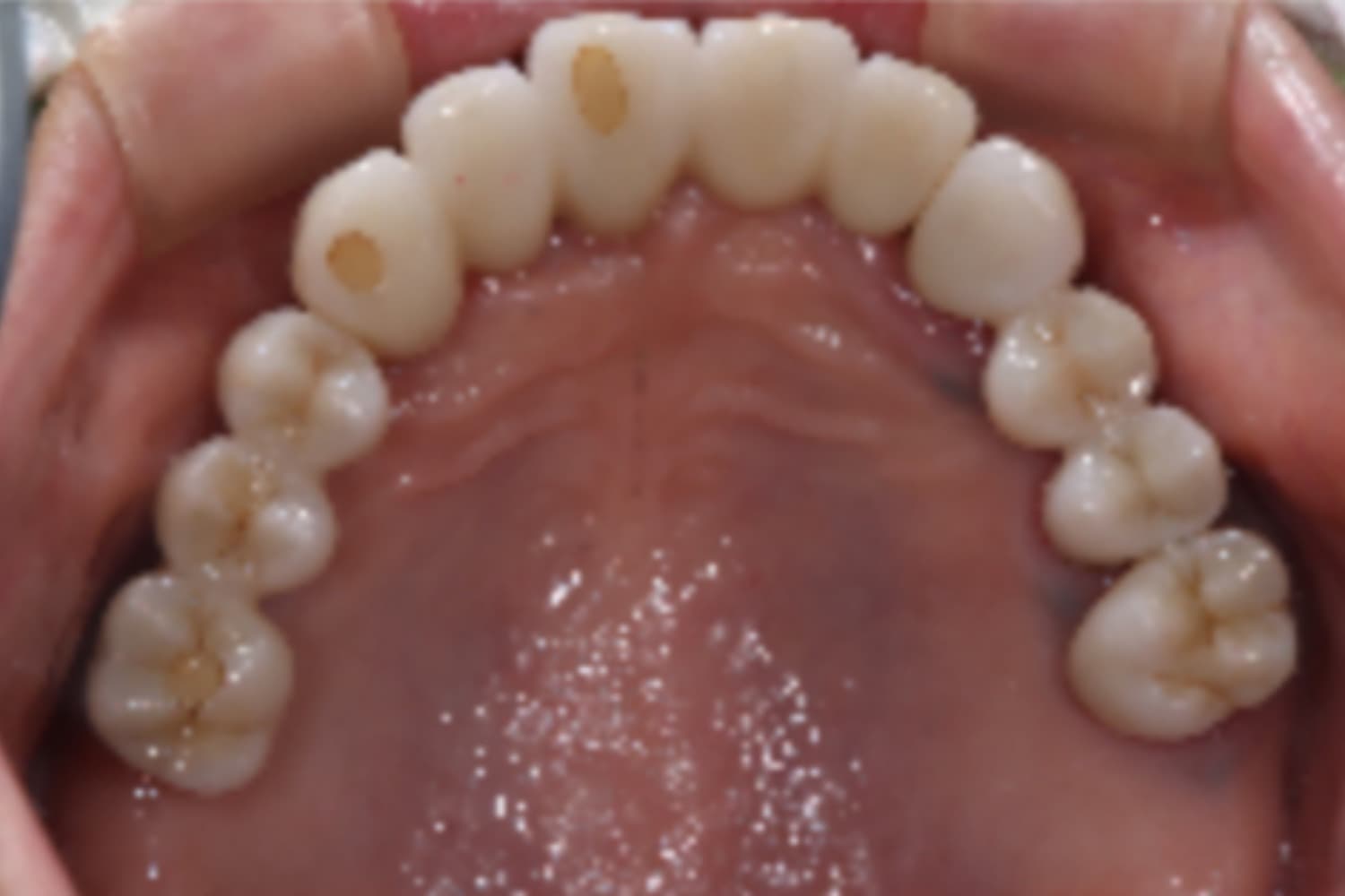 インプラント治療後①