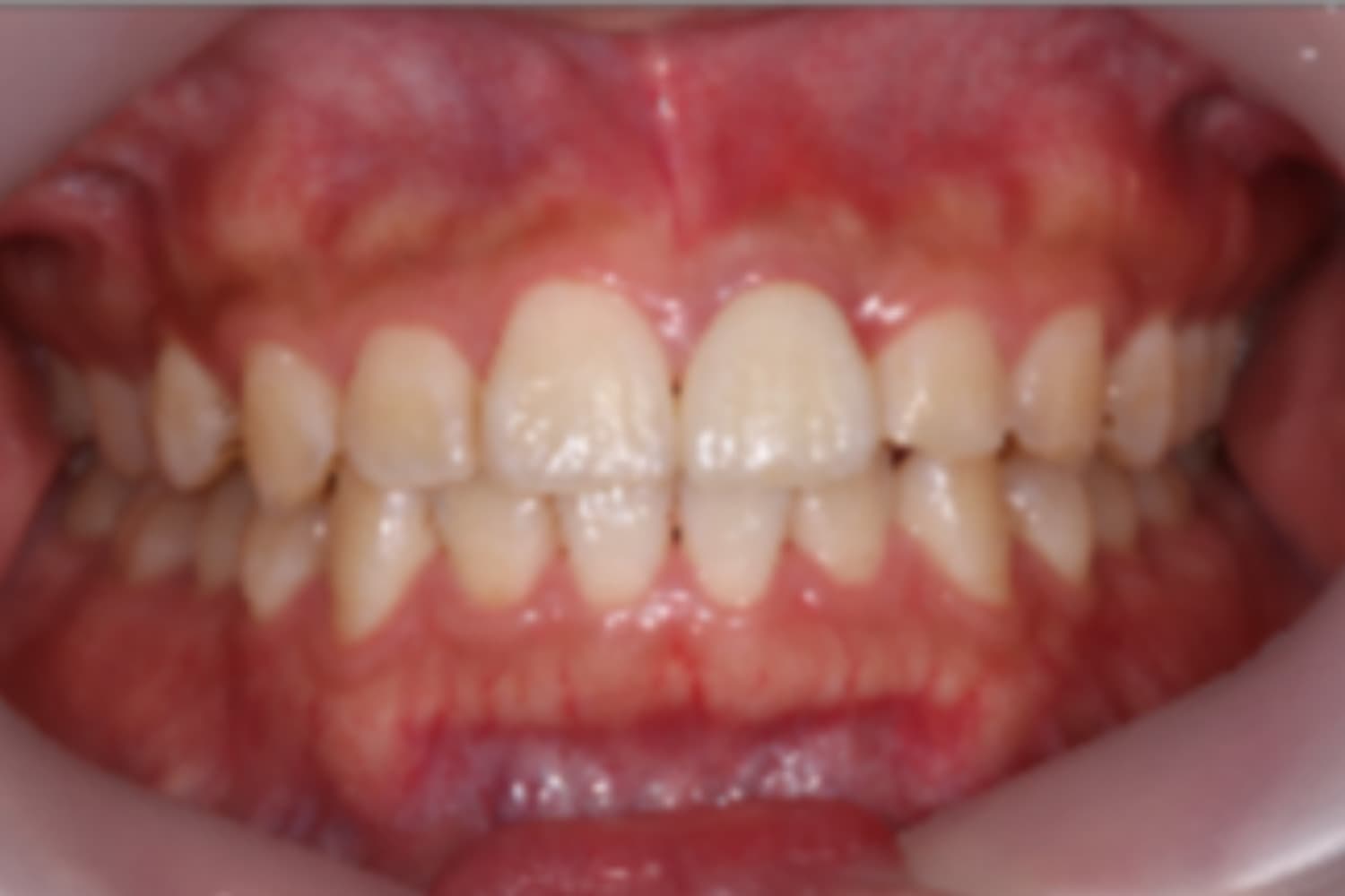 インプラント治療後