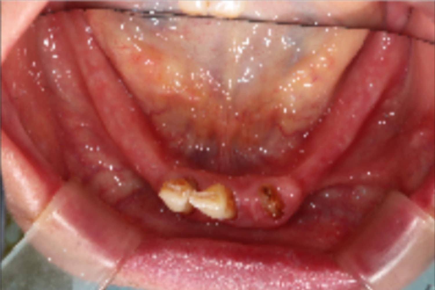 インプラント治療前②