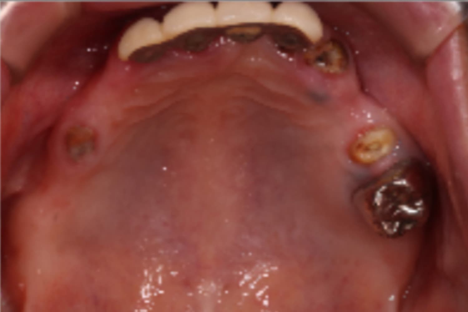 インプラント治療前①