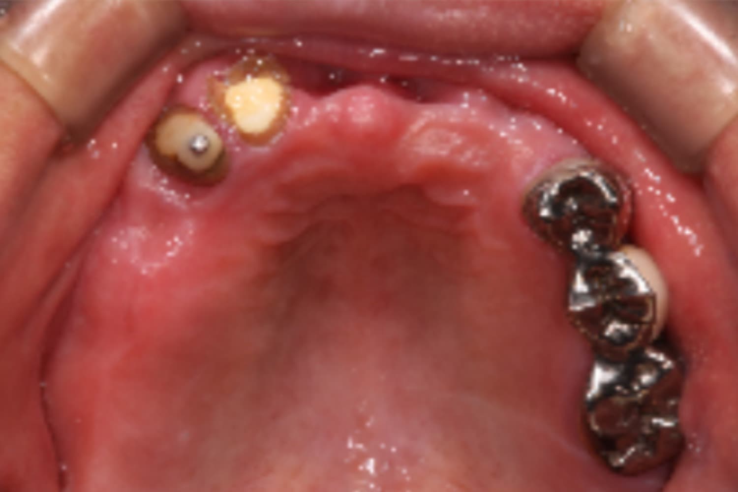 インプラント治療前①