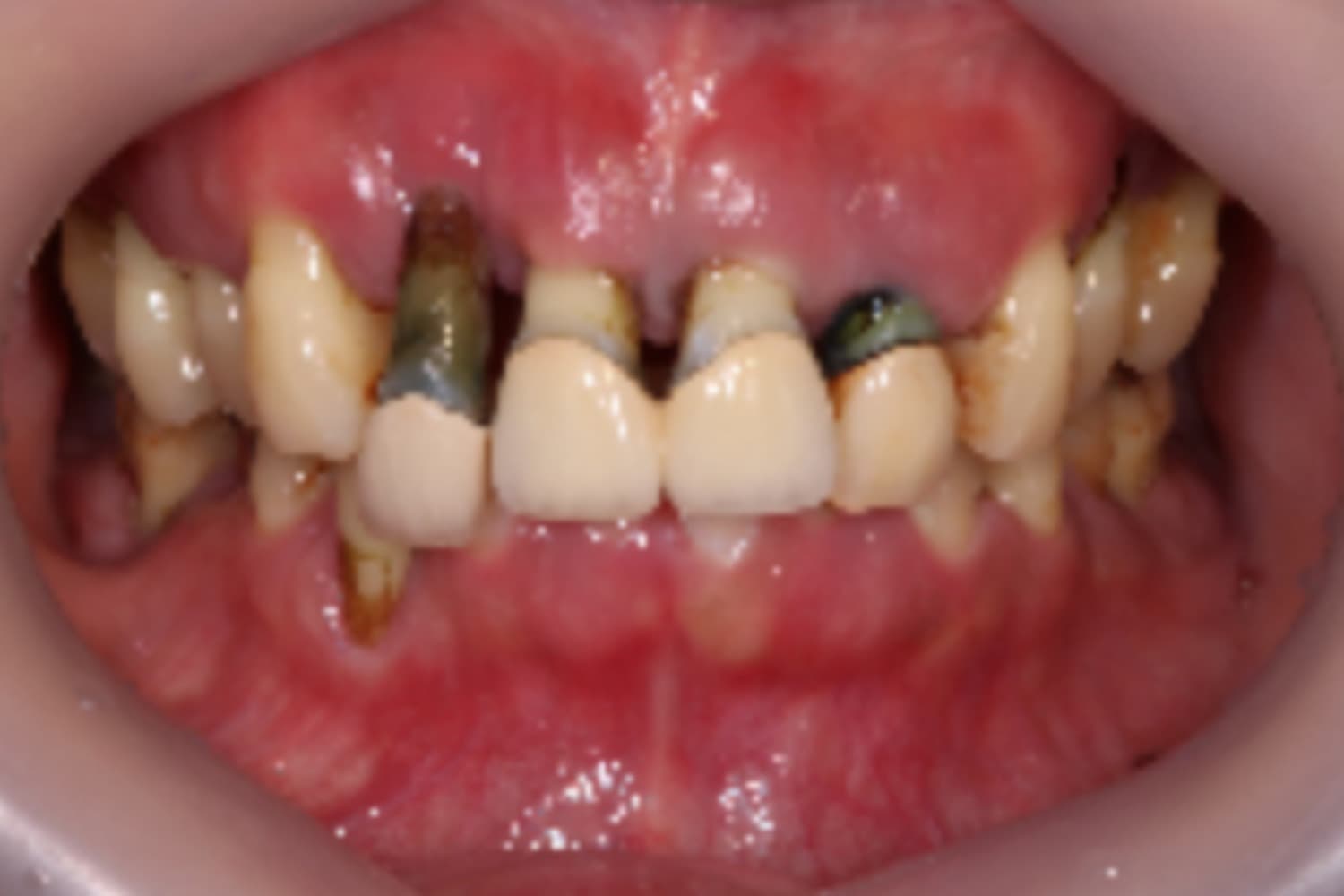 インプラント治療前