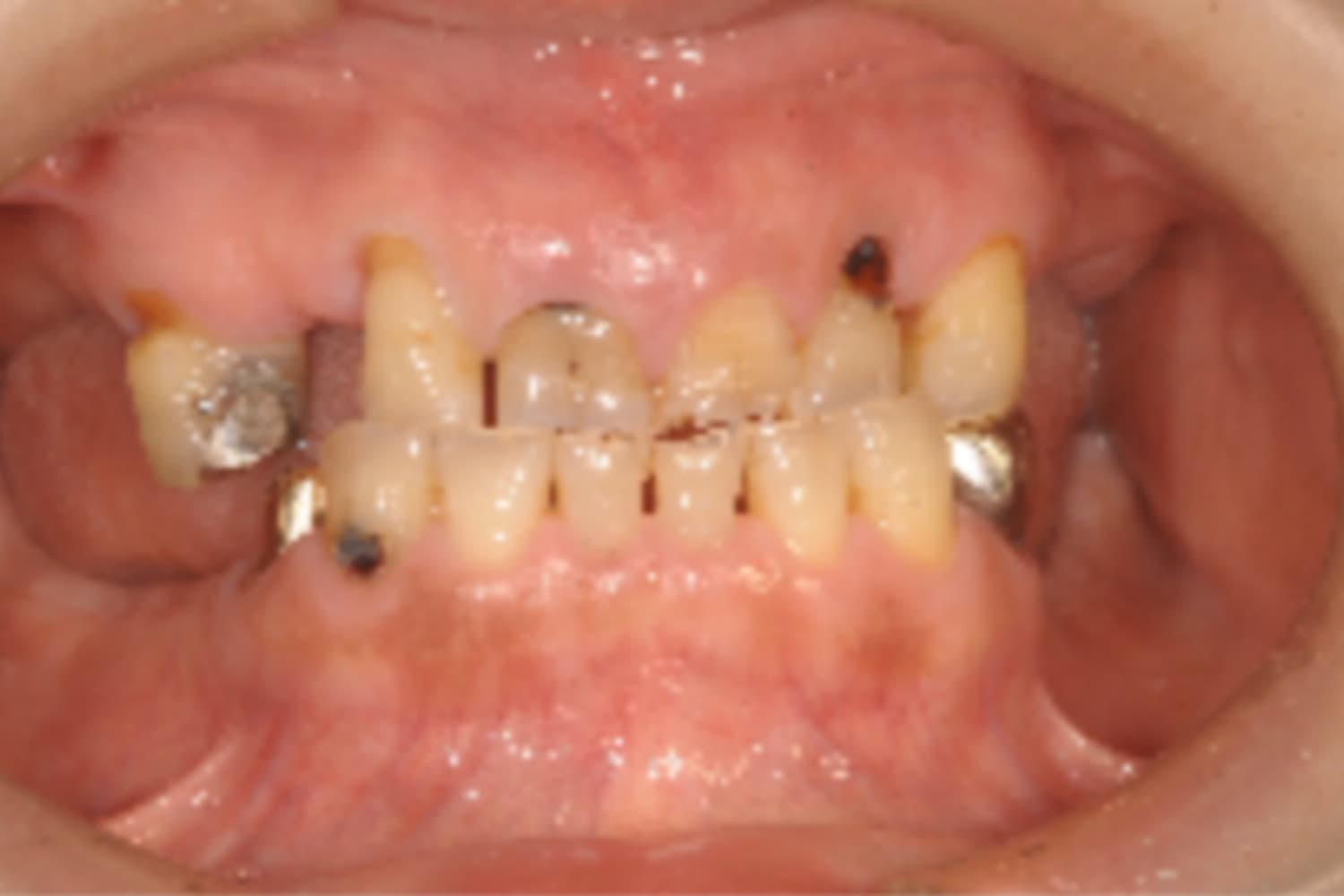 インプラント治療前①