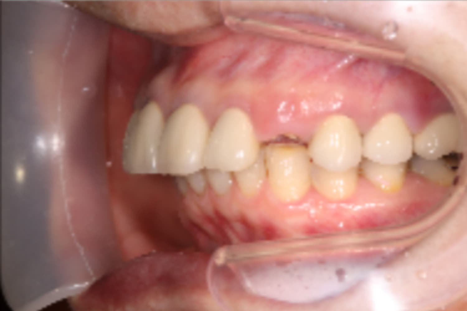 インプラント治療前①