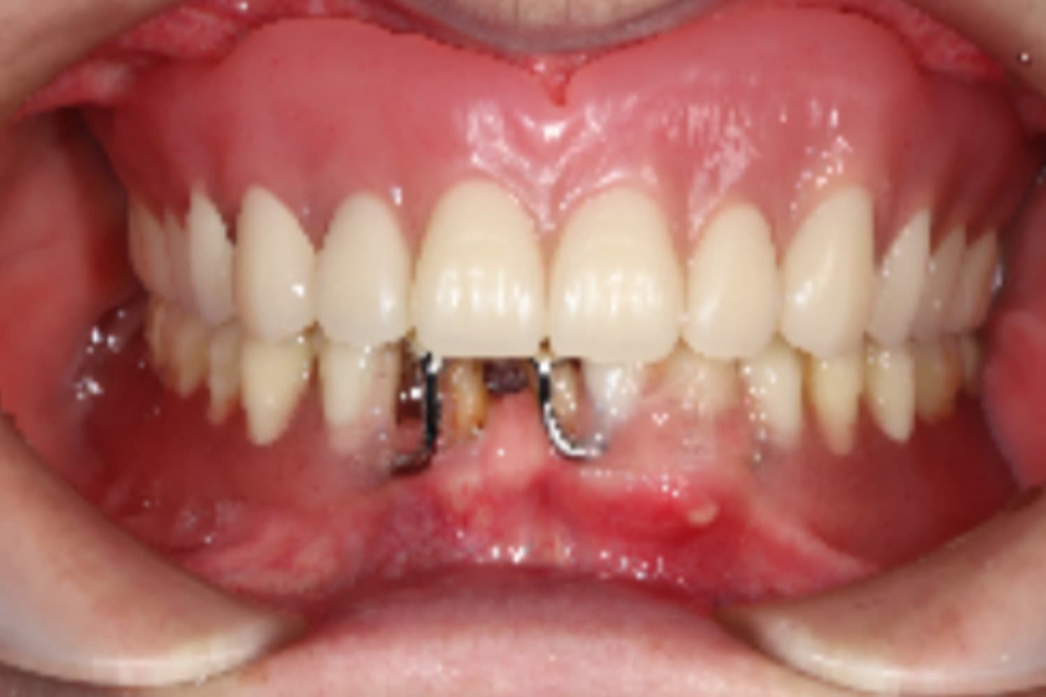 インプラント治療前①