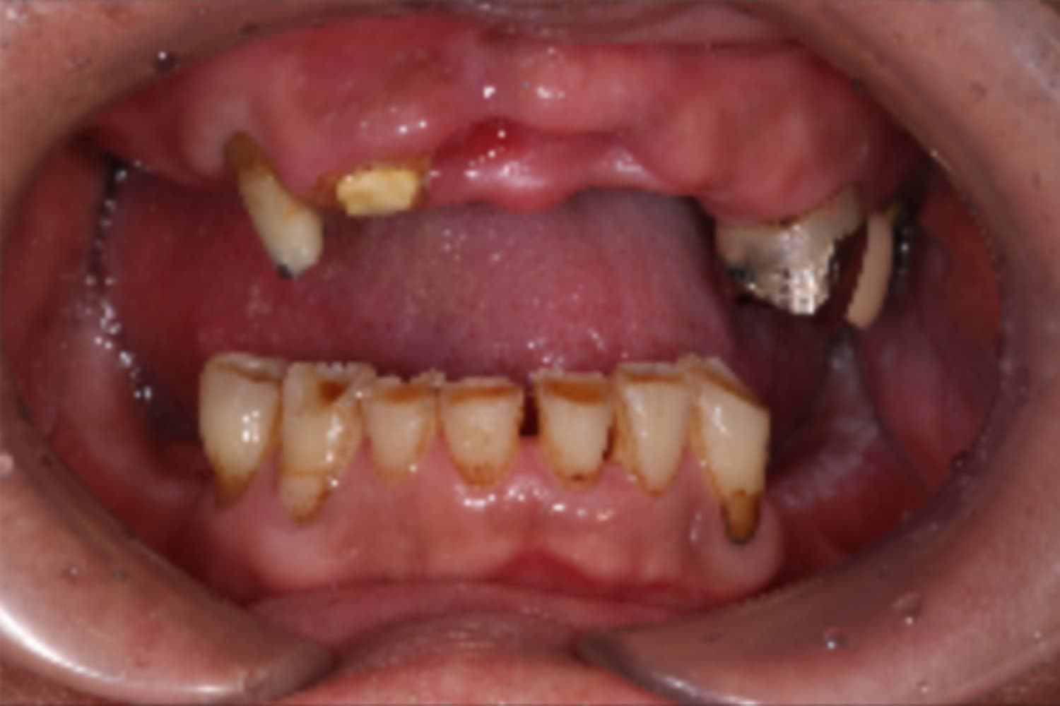 インプラント治療前②