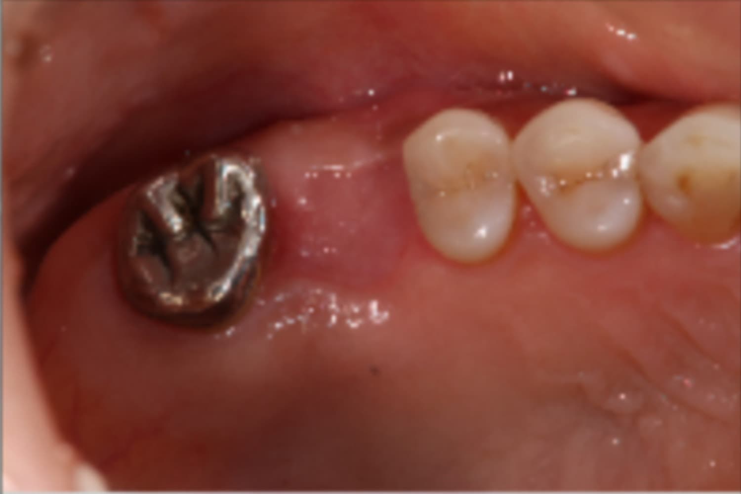 インプラント治療前
