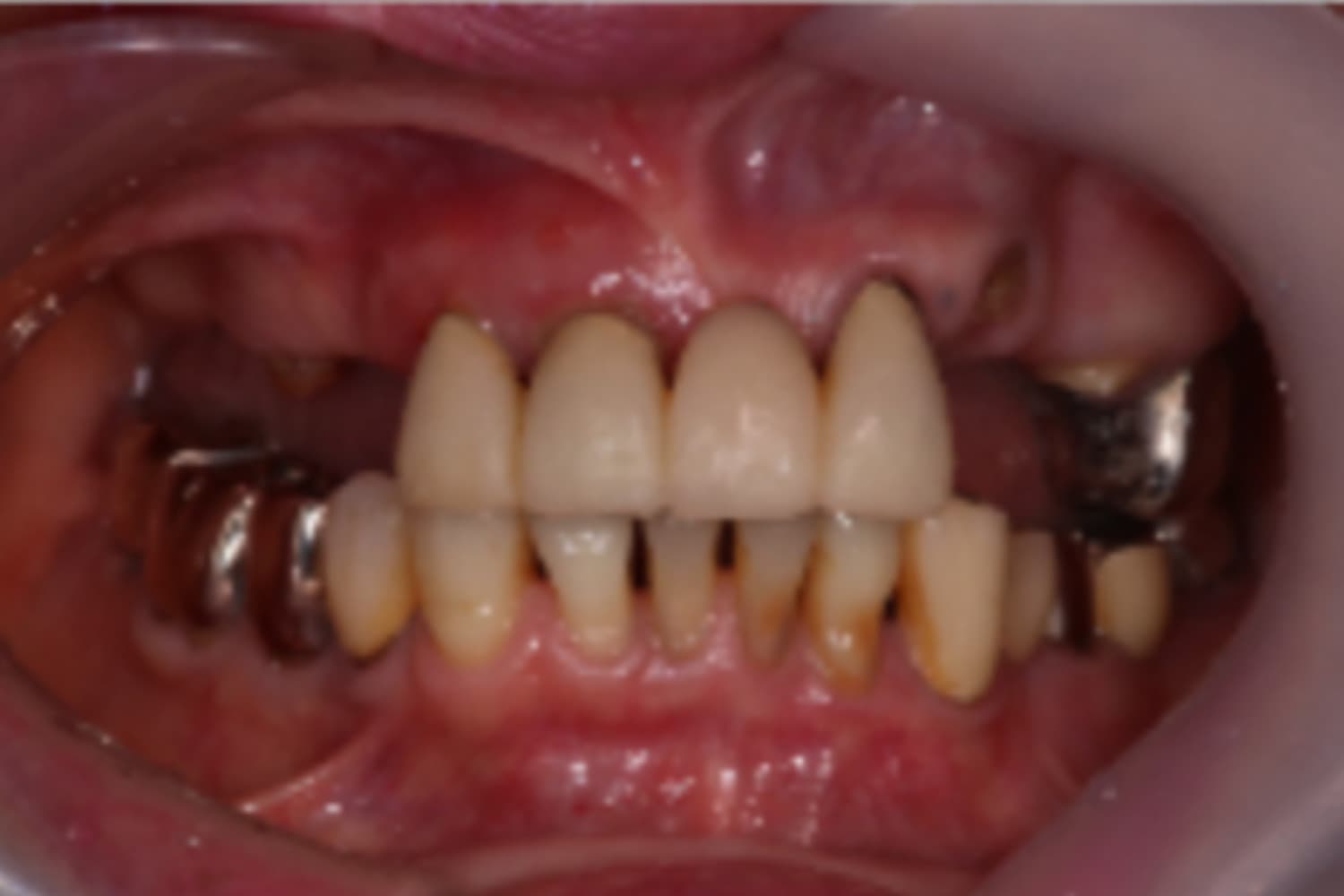 インプラント治療前②