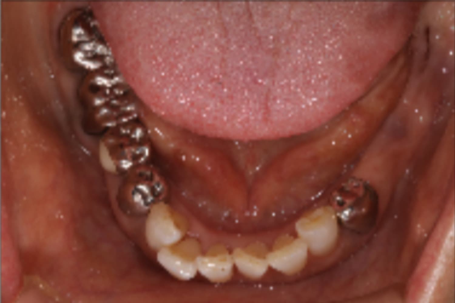 インプラント治療前①