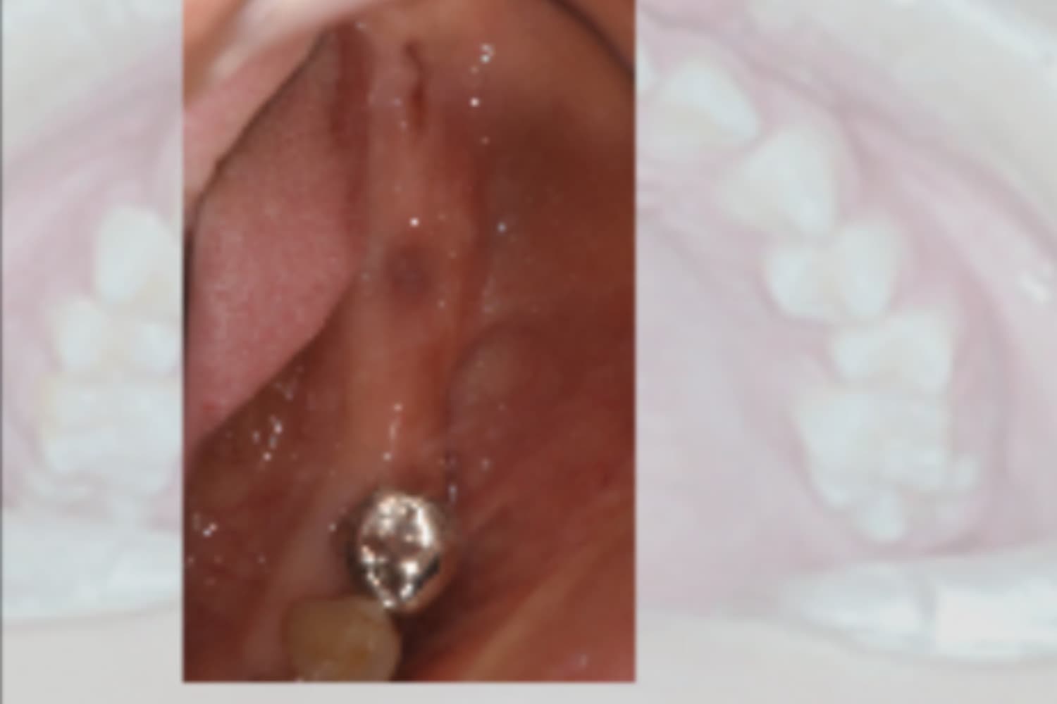 インプラント治療前②