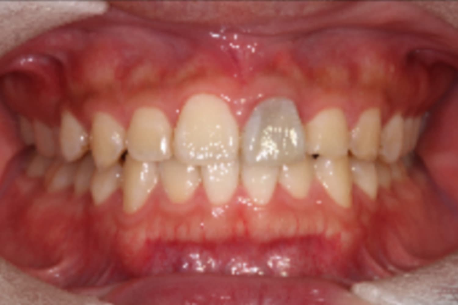 インプラント治療前