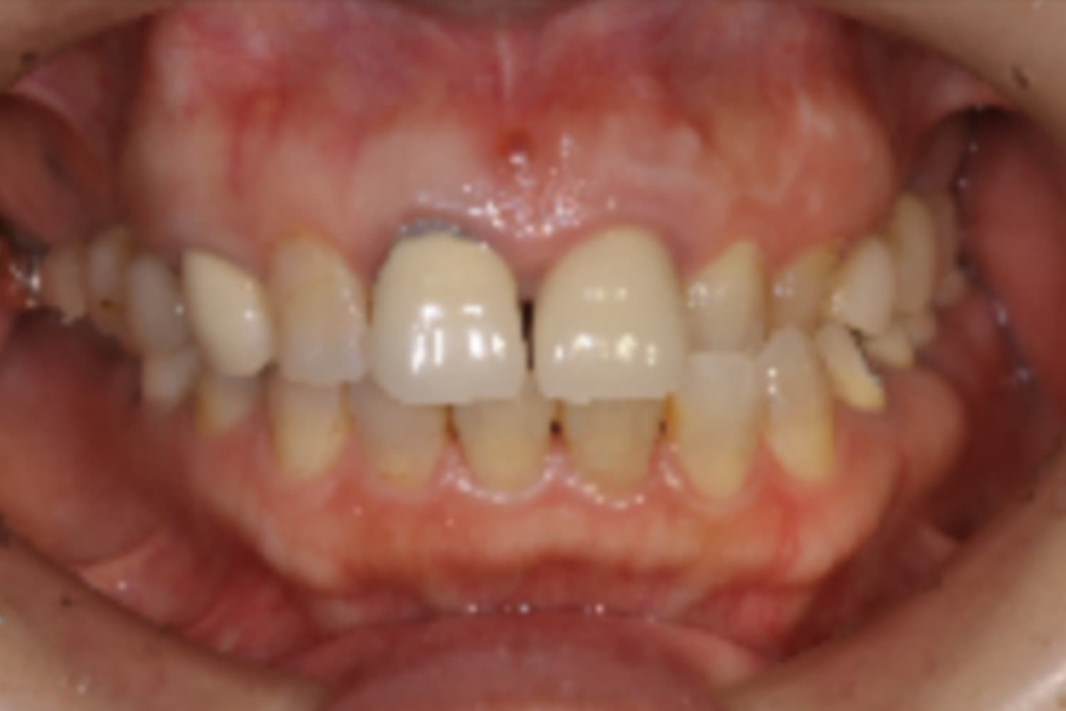 インプラント治療前