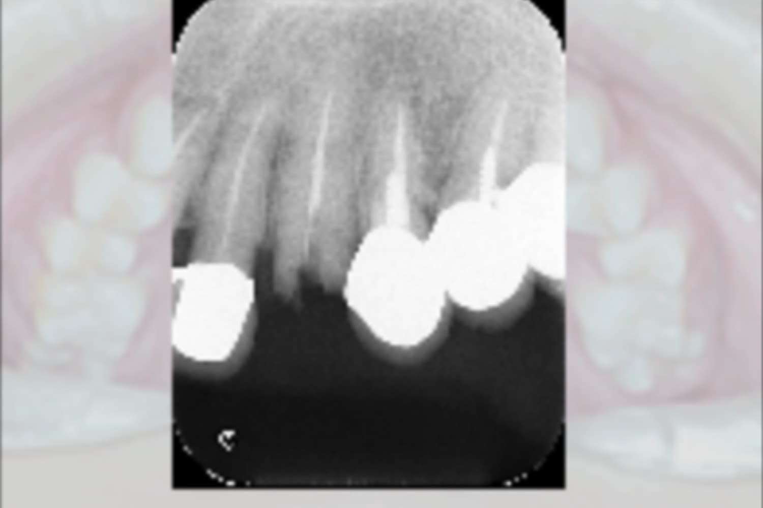 インプラント治療前②