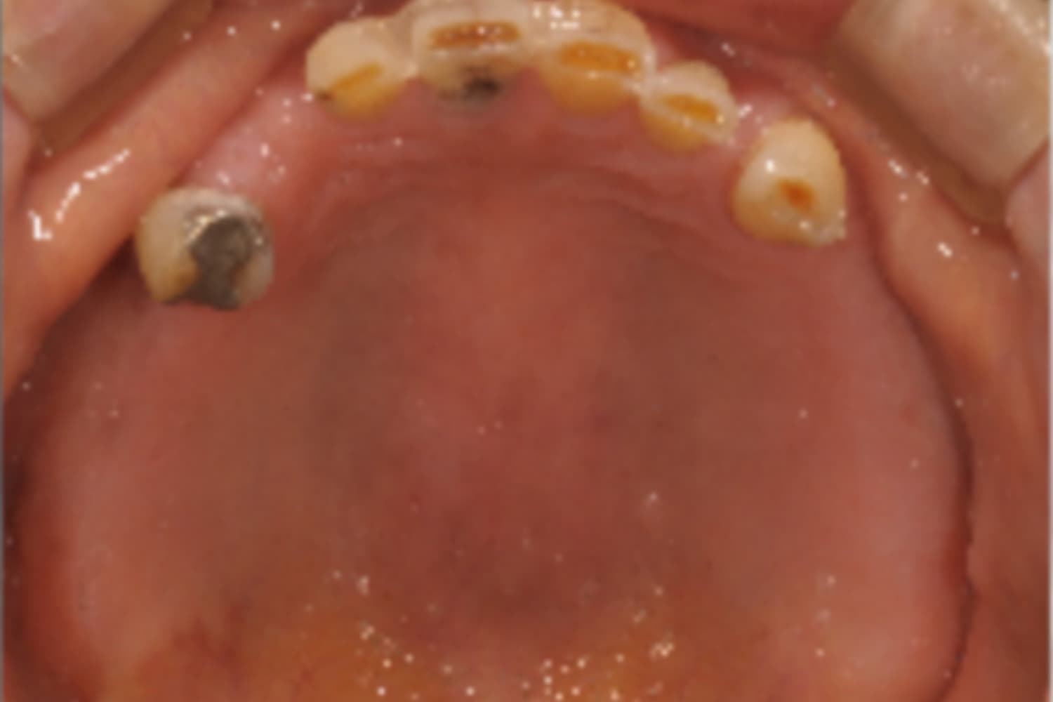 インプラント治療前②