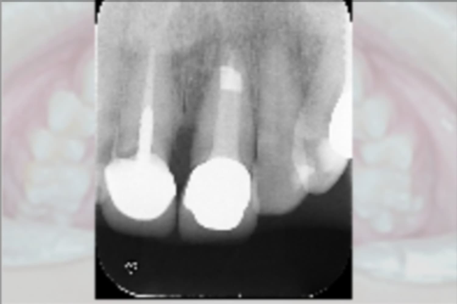 インプラント治療前(レントゲン)