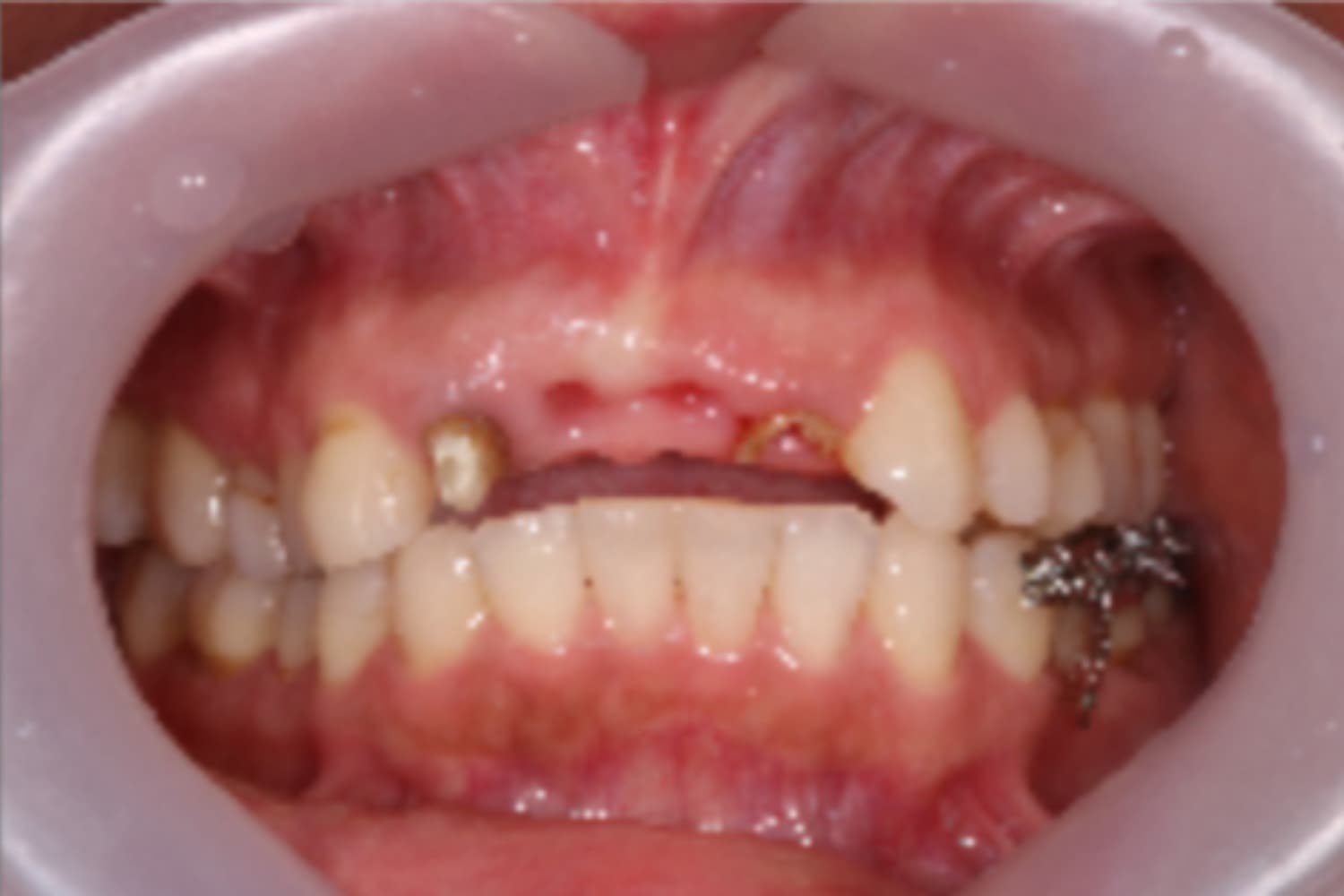 インプラント治療前