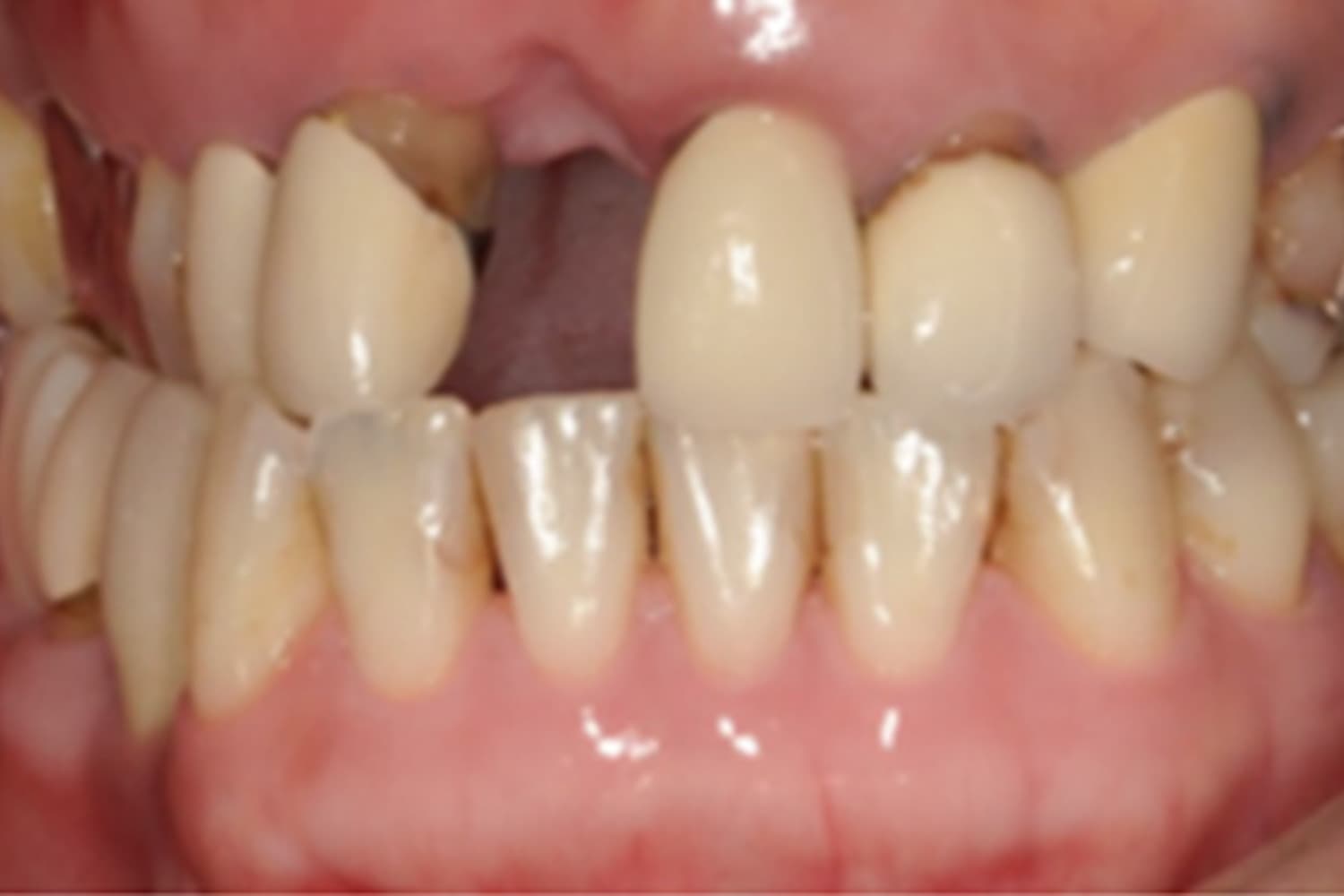 症例⑧インプラント治療前