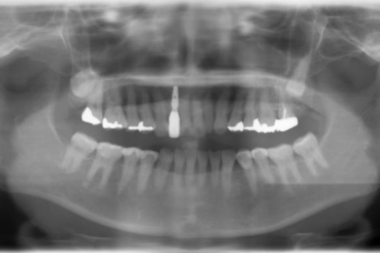 インプラント治療後3(レントゲン)