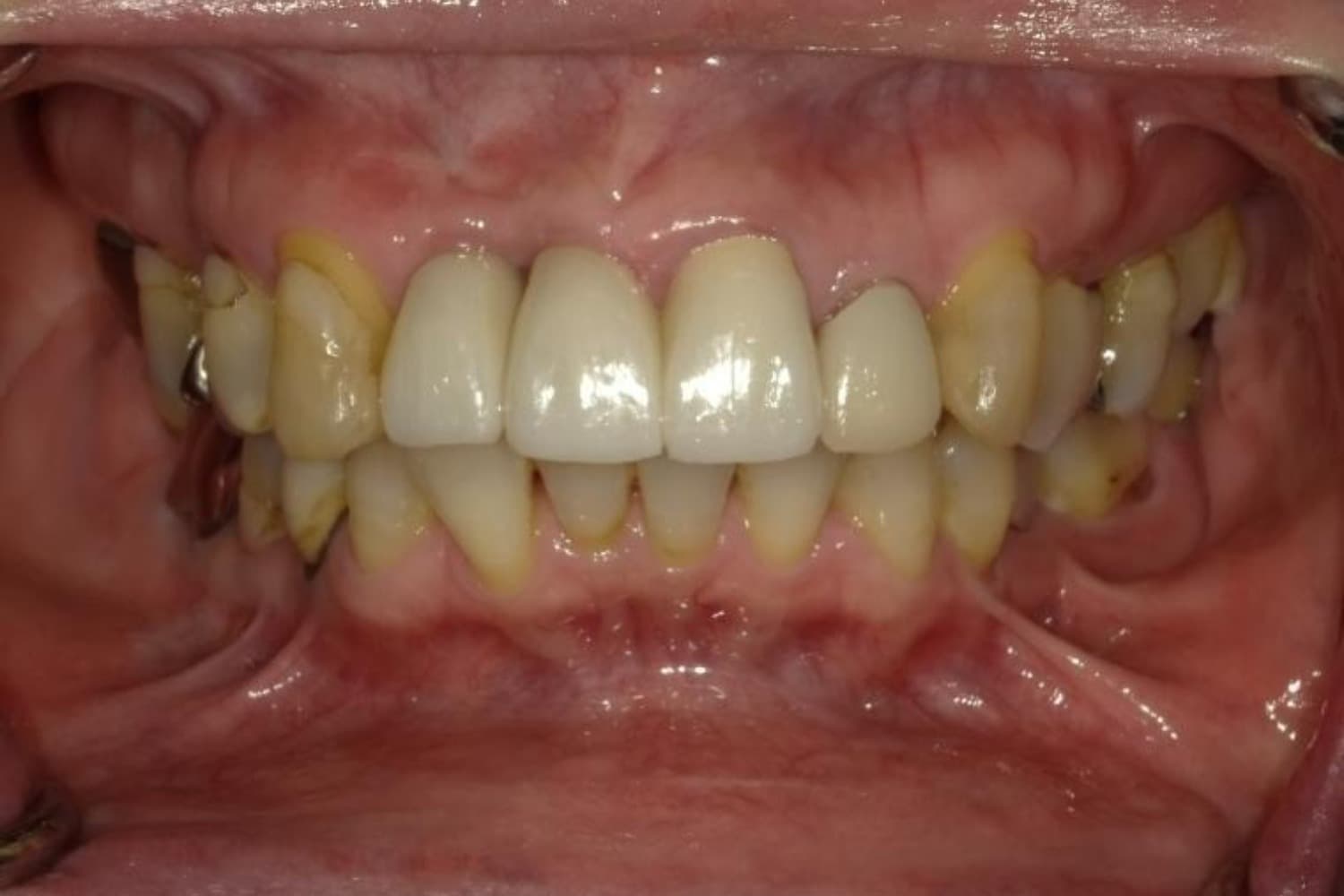 インプラント治療後1