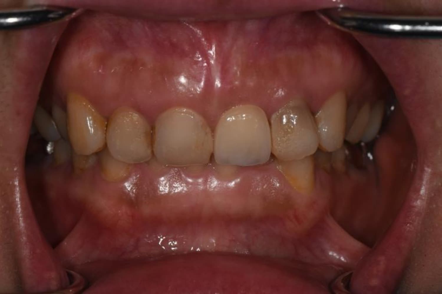 インプラント治療後1